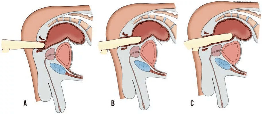 Exame rectal dos dedos